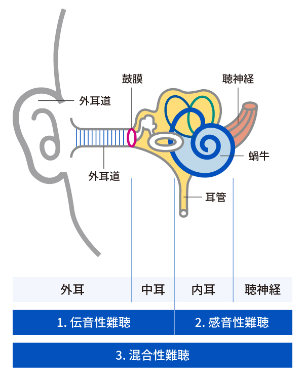 難聴の種類の図解